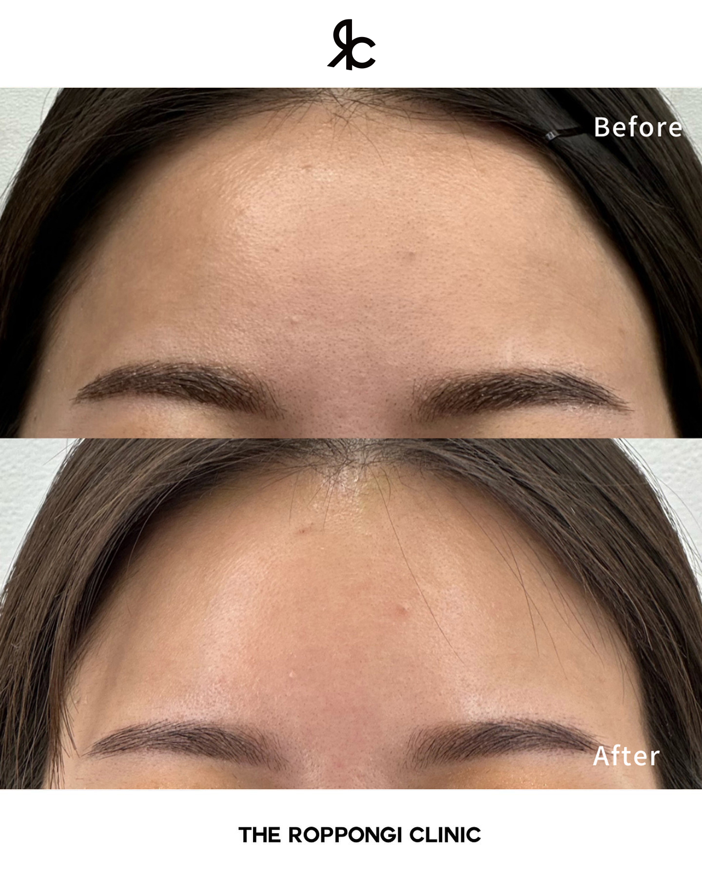 1回でも実感！ザロクの毛穴治療（額）