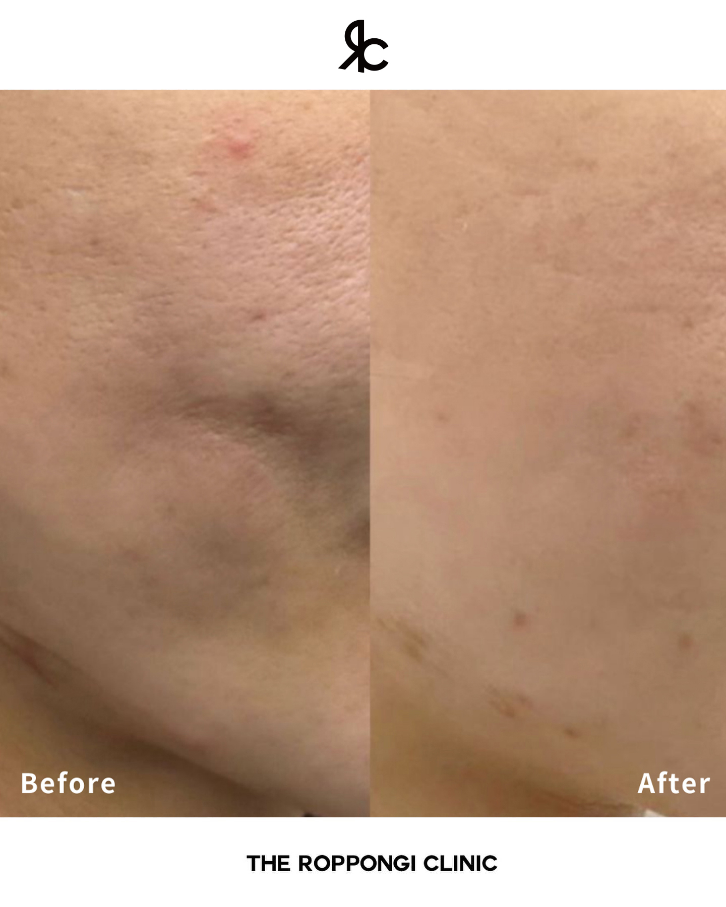 頑固なクレーター毛穴が改善！