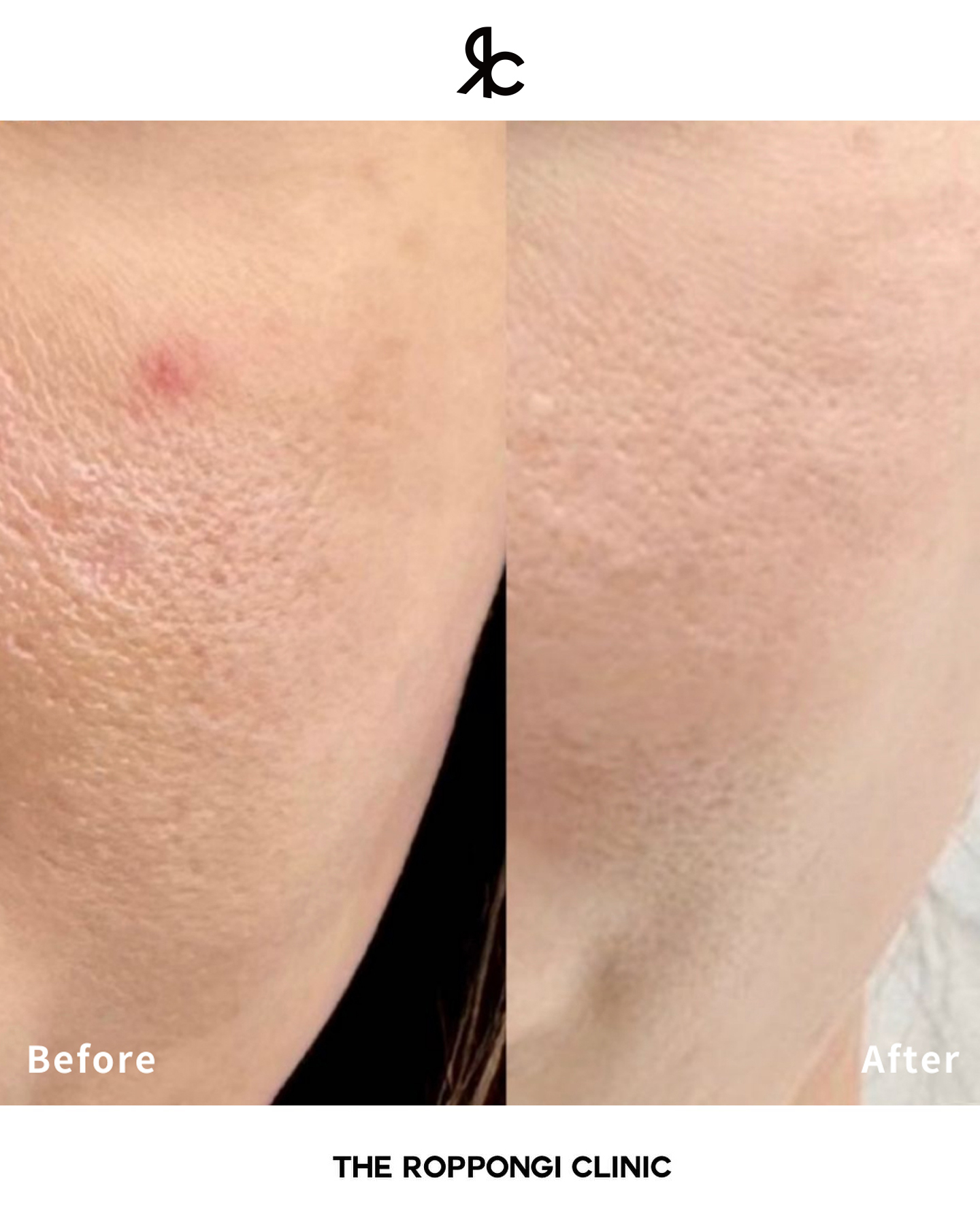 毛穴治療で効果を感じなかった方におすすめの毛穴治療