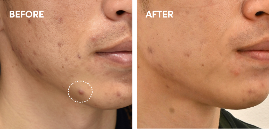 ニキビ治療(ケミカルピーリング)