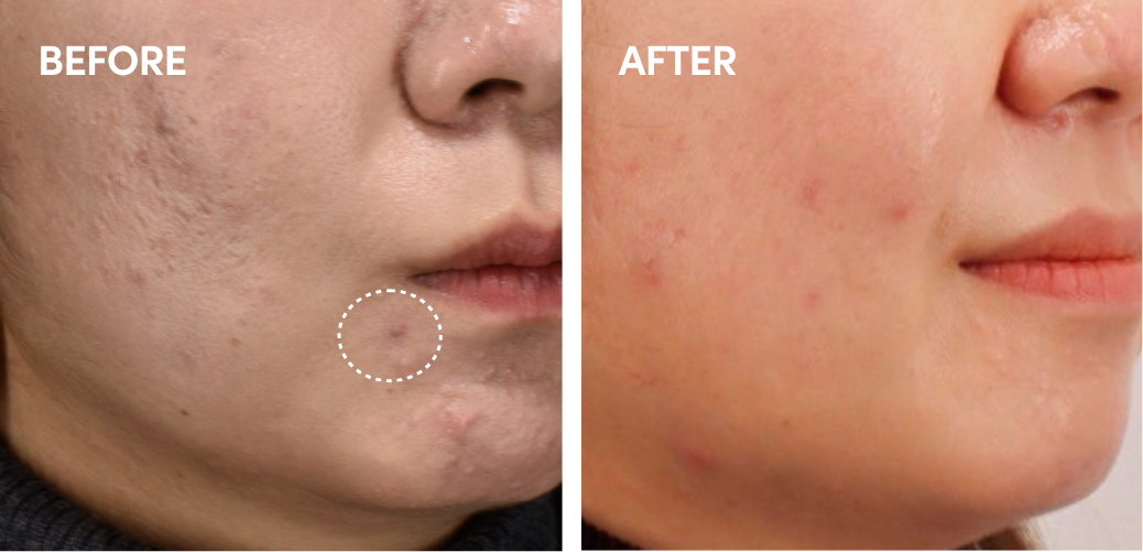 ニキビ治療(Wピコレーザー)