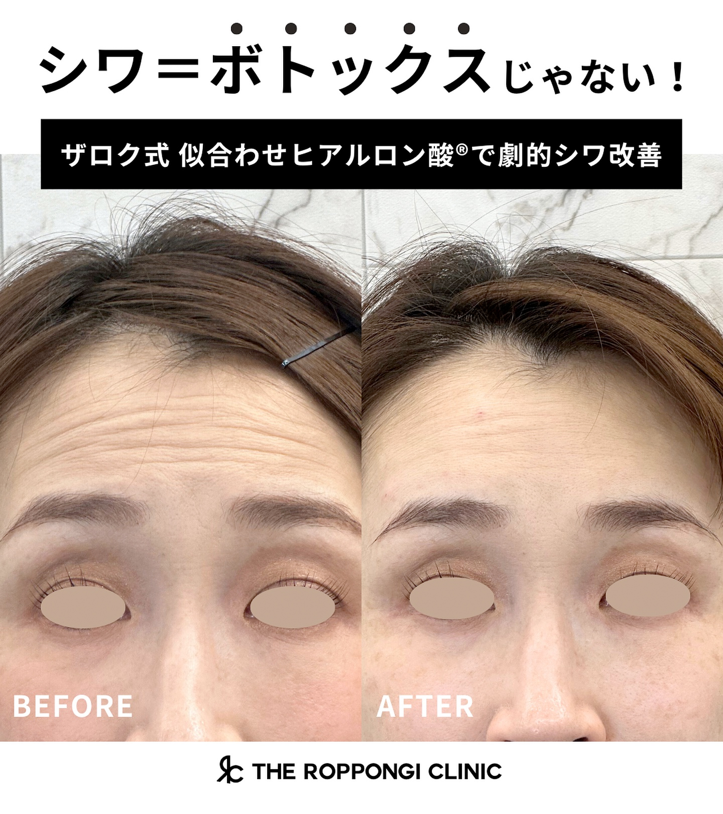 額のヒアルロン酸注射