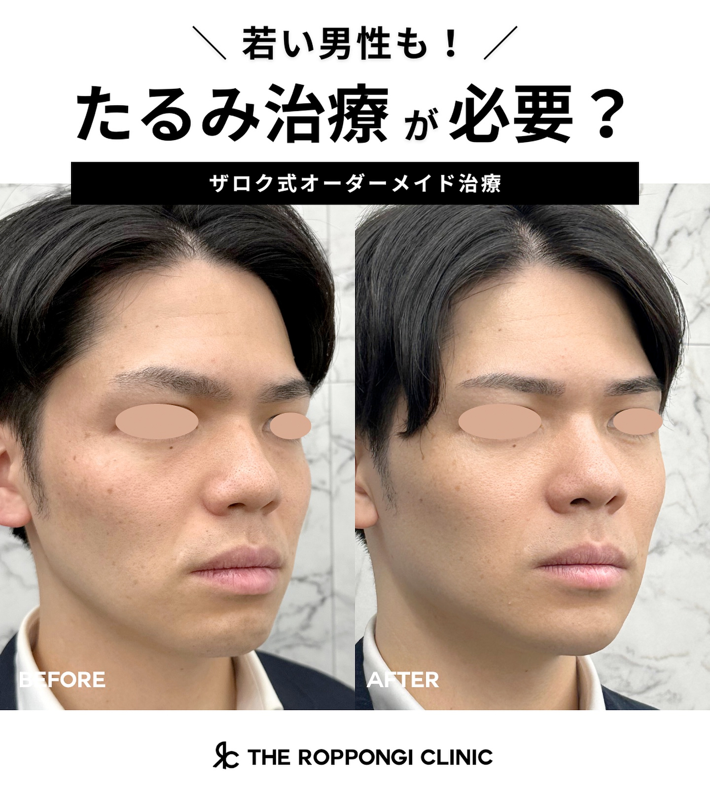 たるみ治療(ヒアルロン酸)