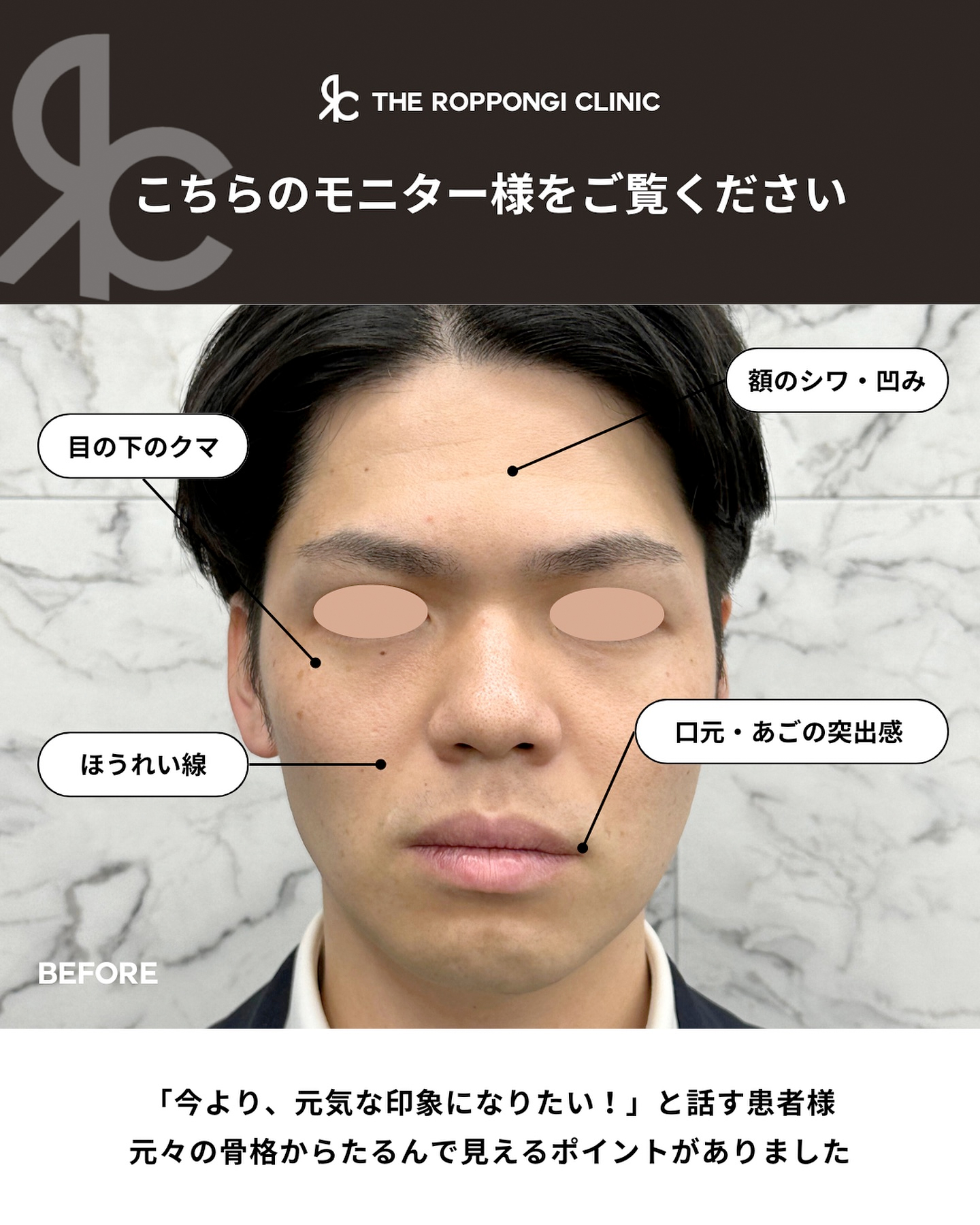 たるみ治療(ヒアルロン酸)