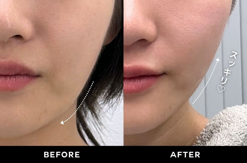 新登場!レーザー照射史上、究極のリフトアップ!