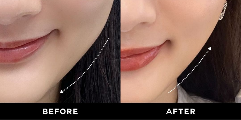 ザロクのオリジナルたるみ治療!