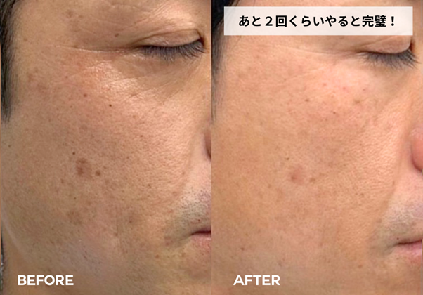 【ザロクのオーダーメイド治療】たるみ治療で−5歳肌へ