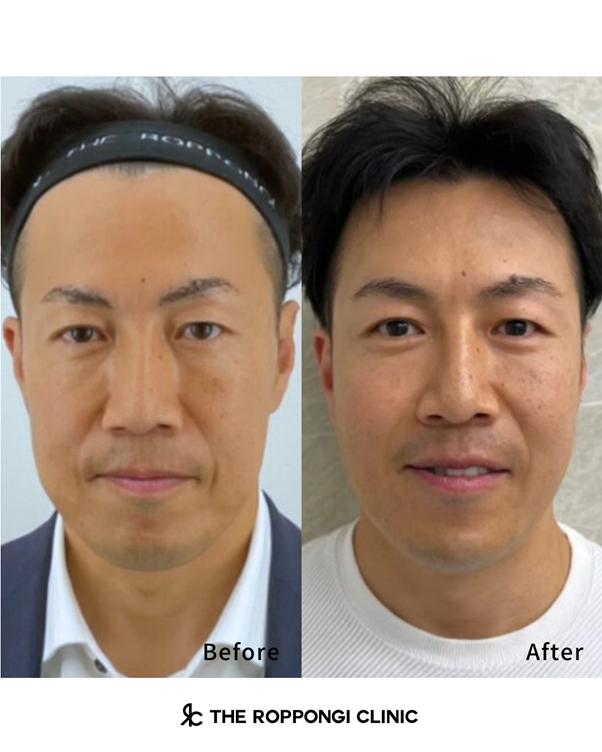 【ザロクのオーダーメイド治療】自然に若返りが叶うメンズ美容医療