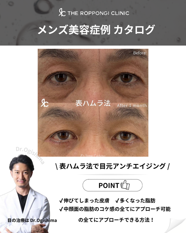 裏ハムラ法で目元アンチエイジング！